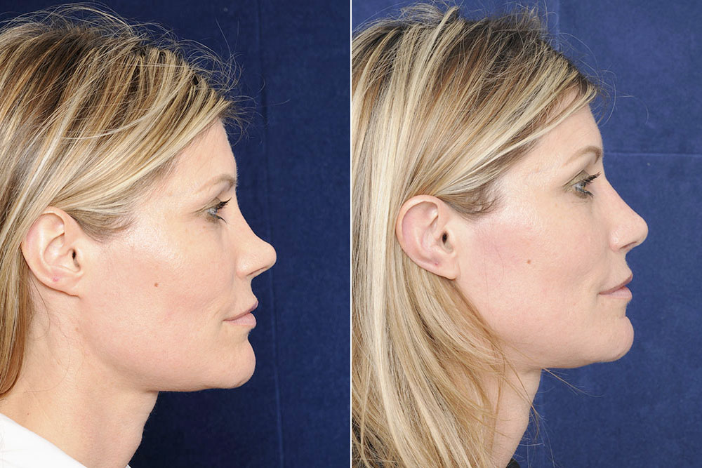 De voor en na foto (zijaanzicht) van een vrouw na een neuscorrectie of rhinoplastie.