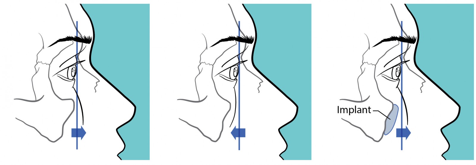 The before and after effect of Medphor implants