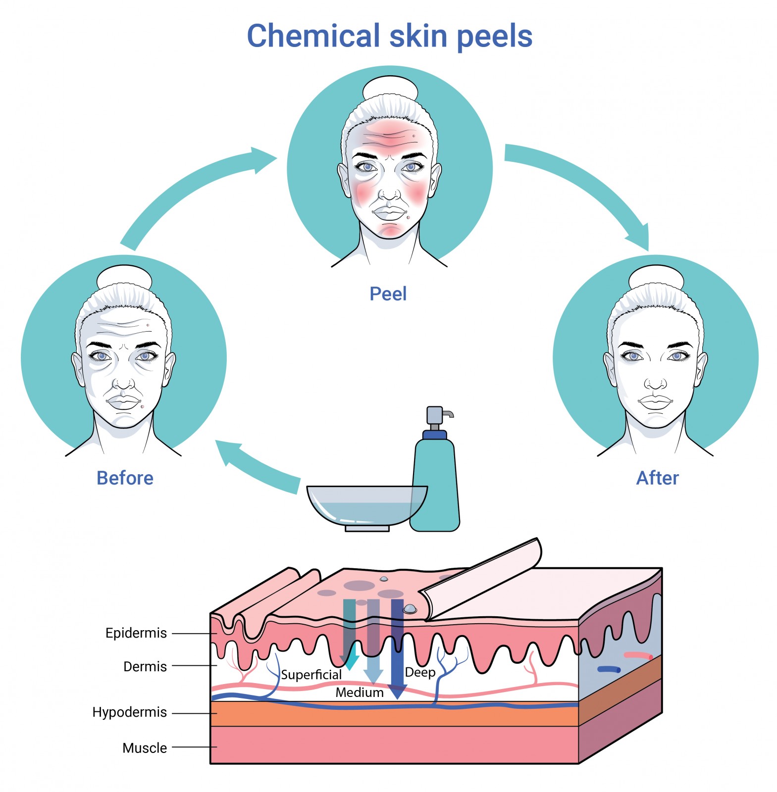 Gelaatschirurgie chemische peeling voor en na behandeling te antwerpen