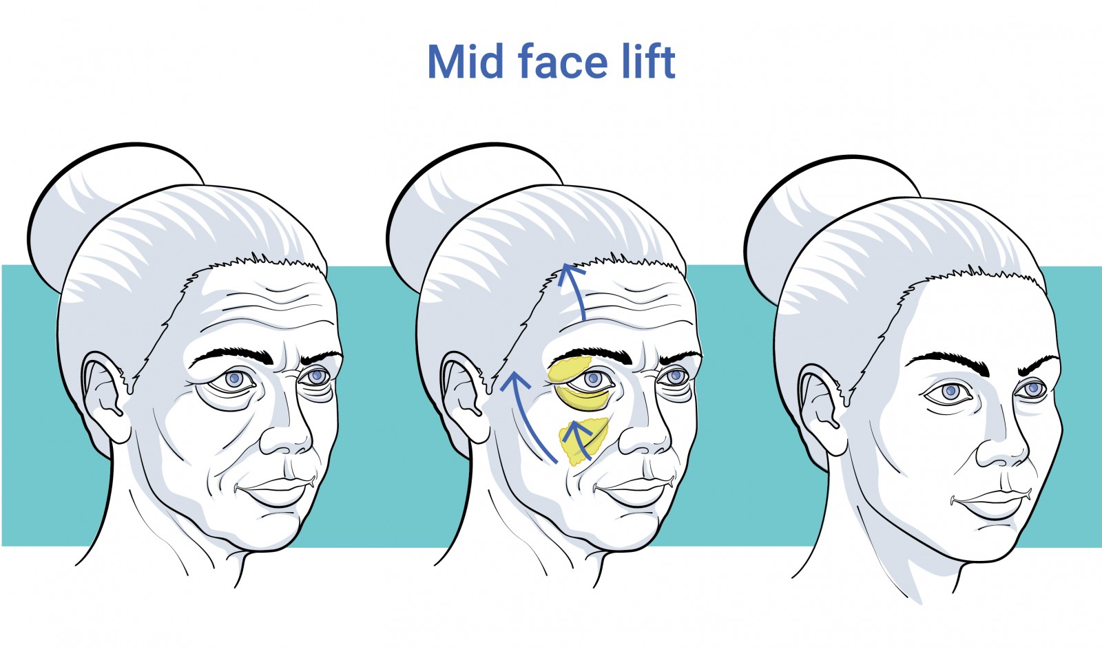 Gelaatschirurgie midfacelift voor en na behandeling te antwerpen