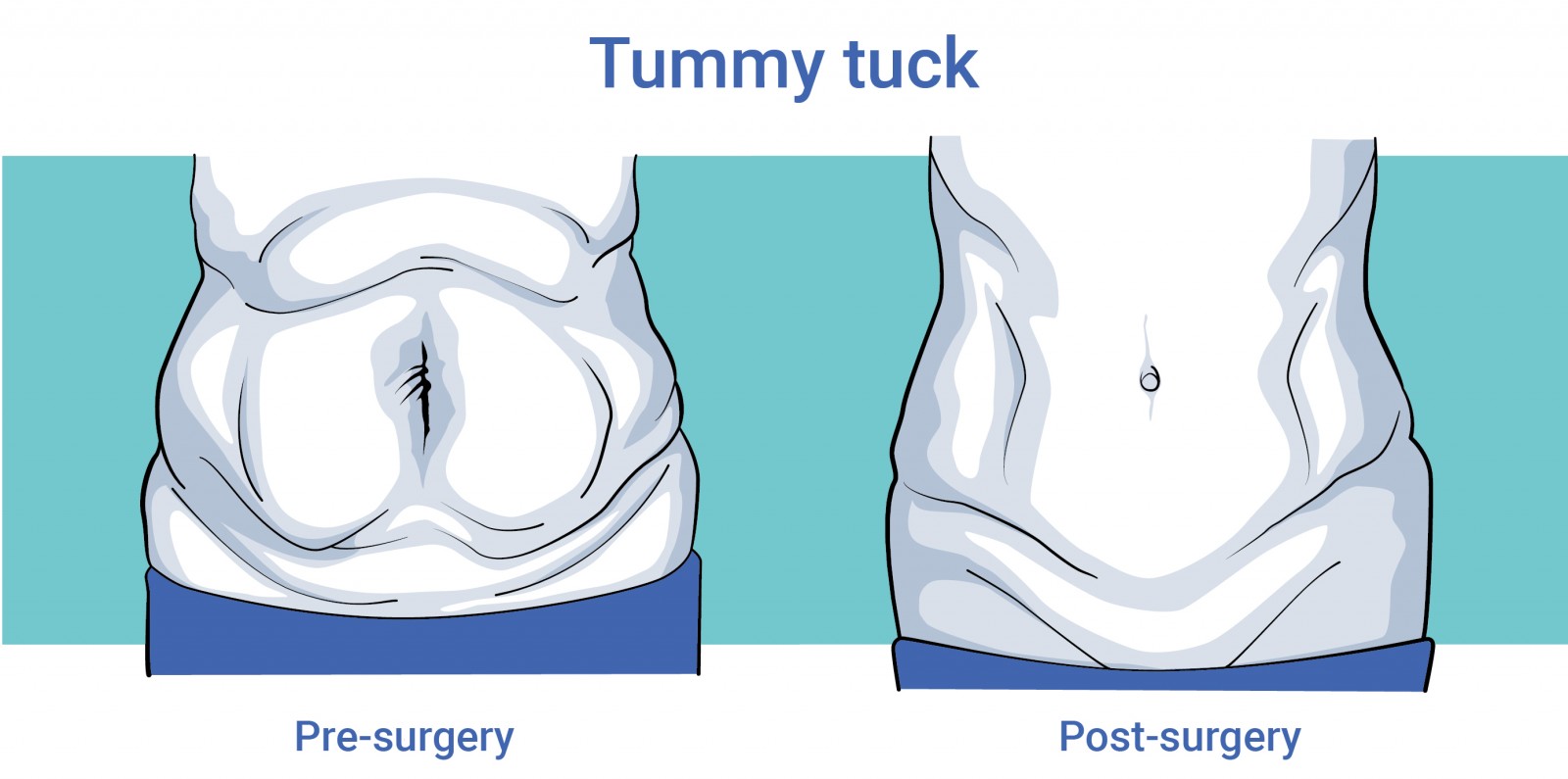 Body surgery abdominoplasty tummy tuck before and after surgery in antwerp