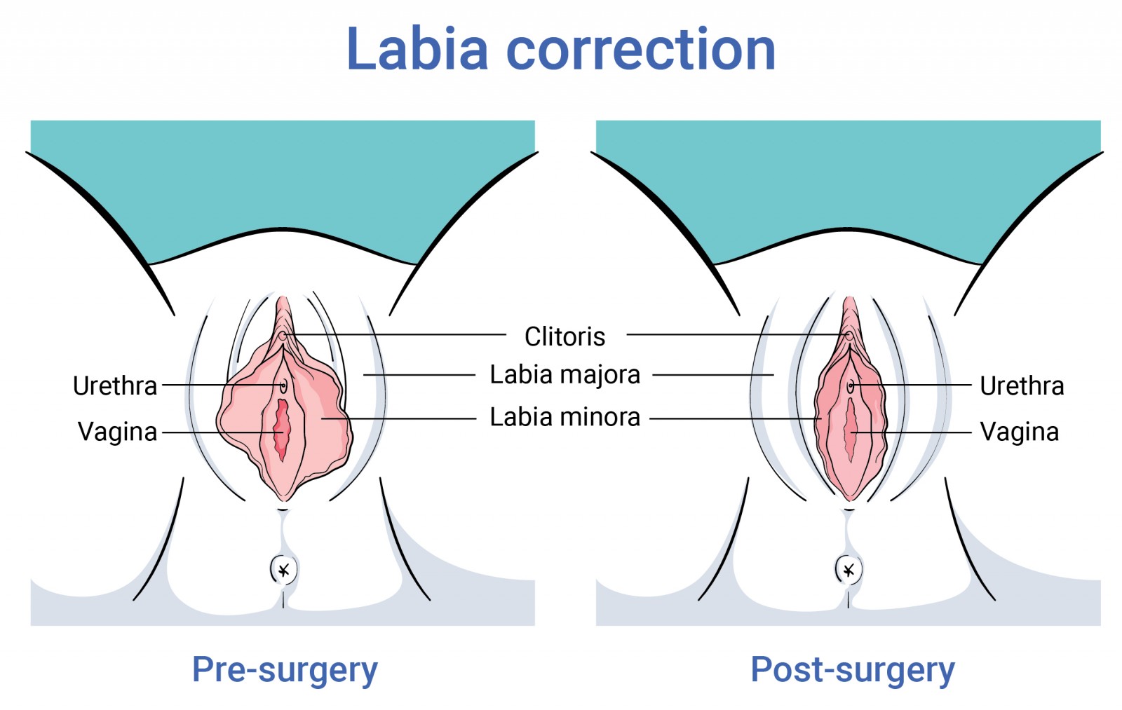 Body surgery labia correction before and after surgery in antwerp