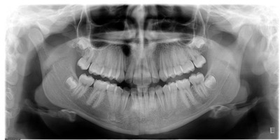 Een orthopantomogram van de kin en de kaak.