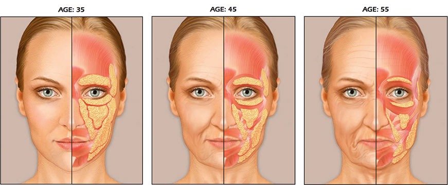 A sketch of the fatty tissue in the face, depending on your age.