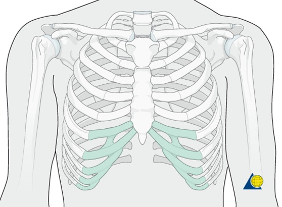 A sketch of the donor area when undergoing a secondary rhinoplasty using a rib graft