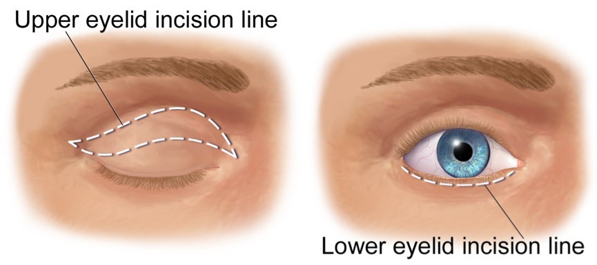 A sketch of the incision lines during a blepharoplasty or eyelid correction.