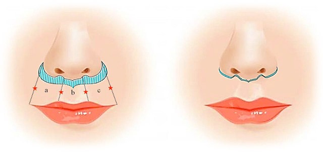 A sketch of a lip lift procedure.