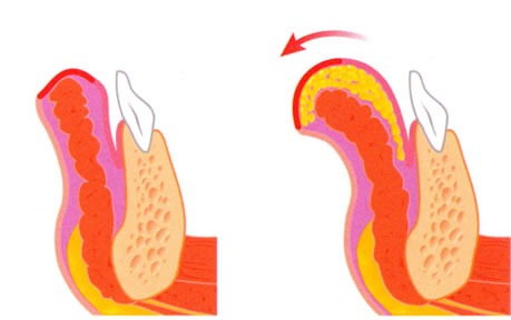 A sketch of lipofilling using a fat injection to enhance the lower lip..