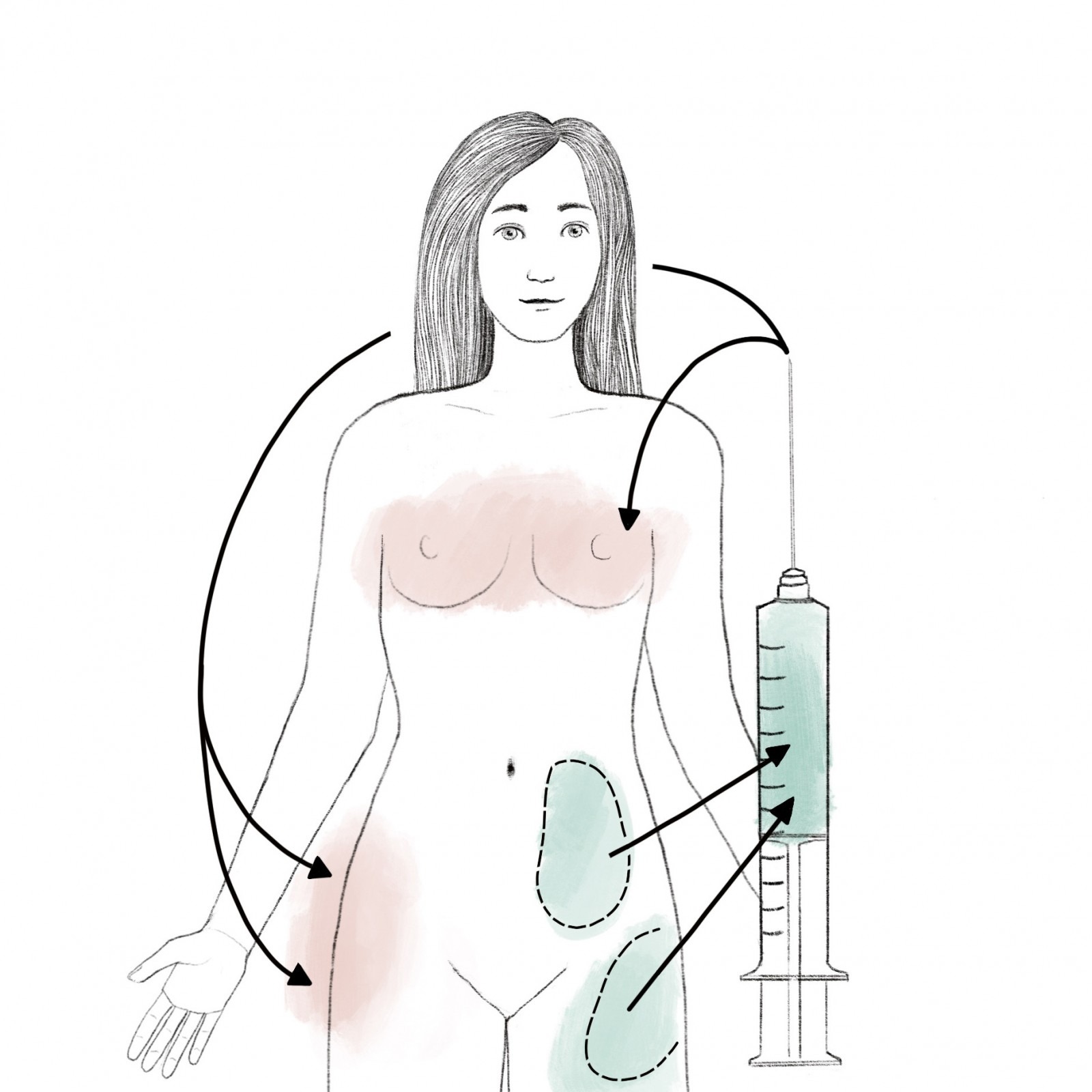 A sketch of a fat transfer indicating the donor and recipient areas.