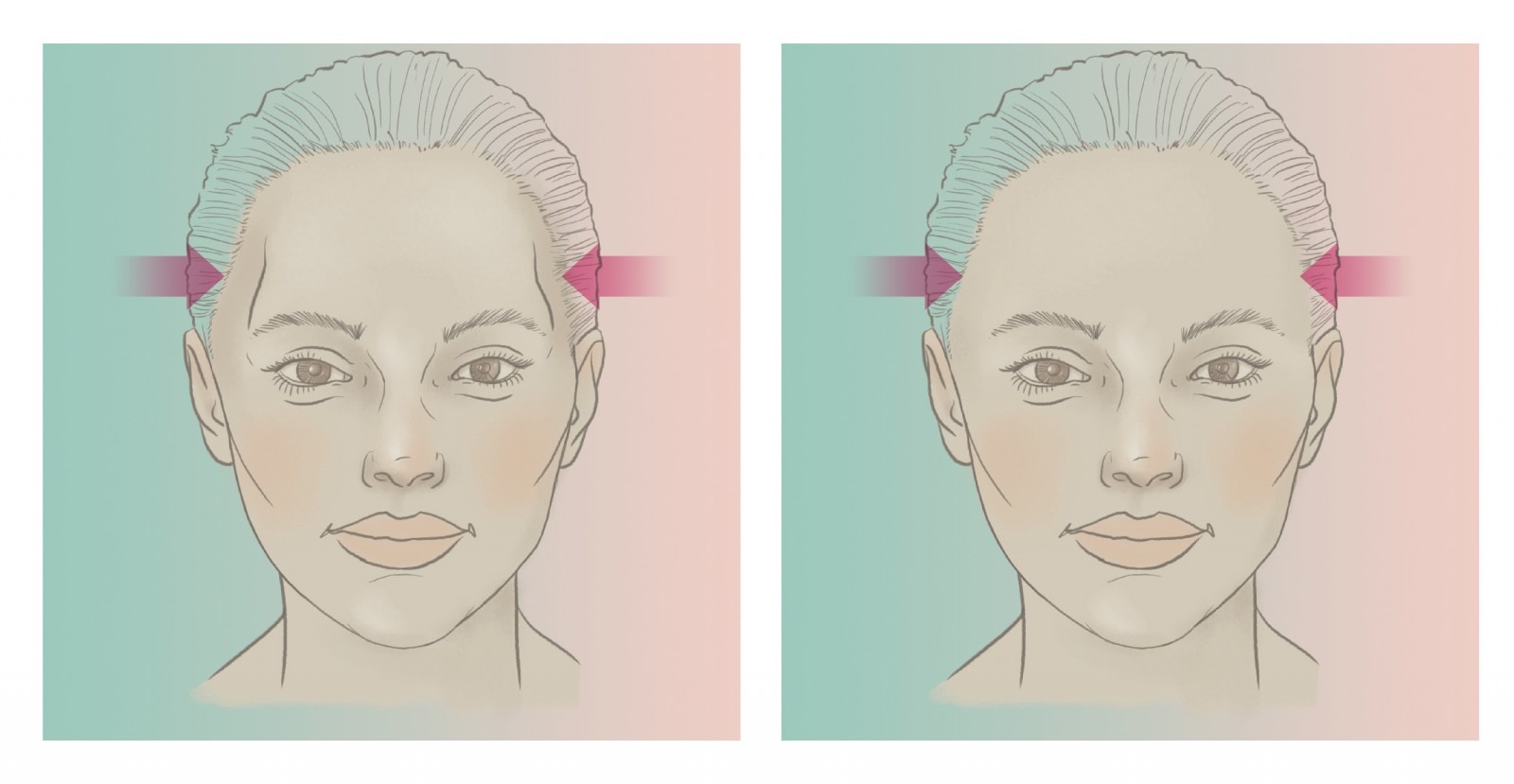 Temporele PEEK implantaten voor en na