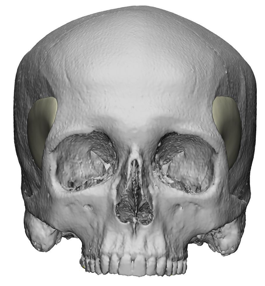 Temporele PEEK implantaten op een 3D scan