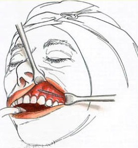 A sketch of the incision area when inserting Medpor implants.