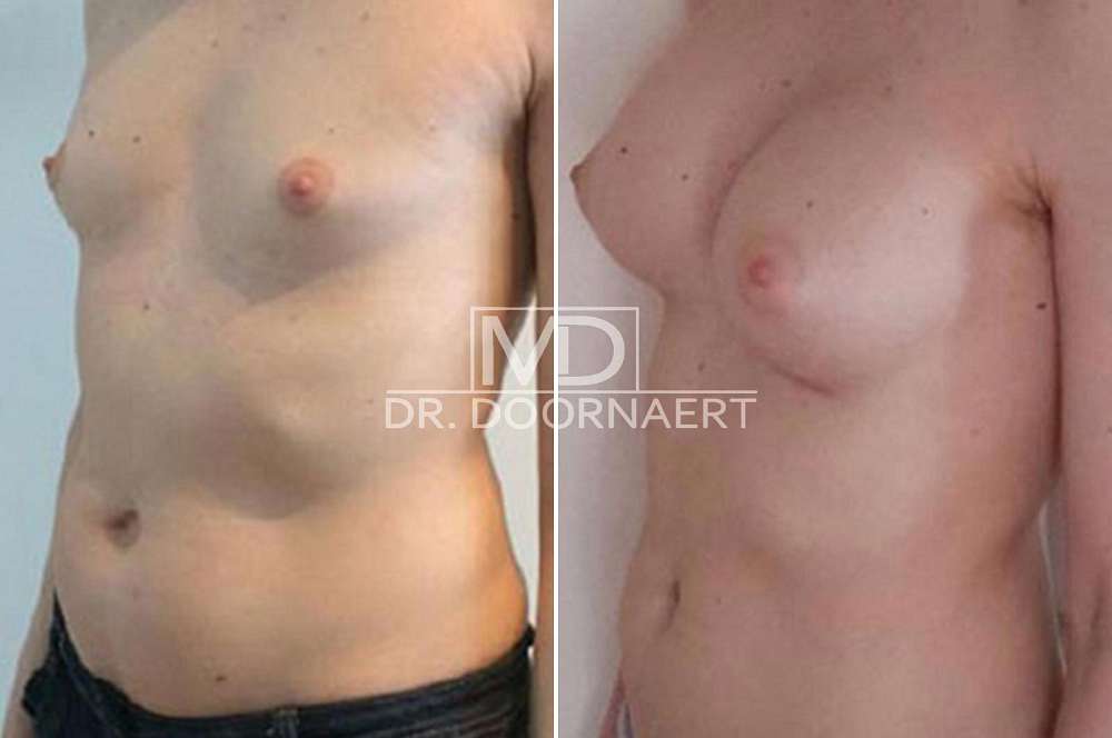 Breast augmentation - Body surgery