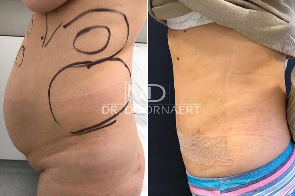 Tummy Tuck Surgery - Body surgery