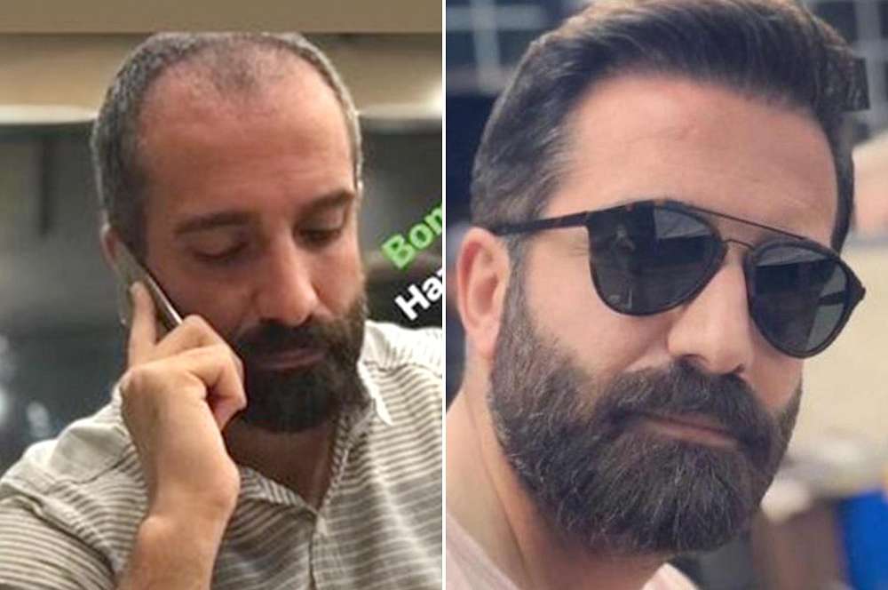 Hair transplant - Hair surgery