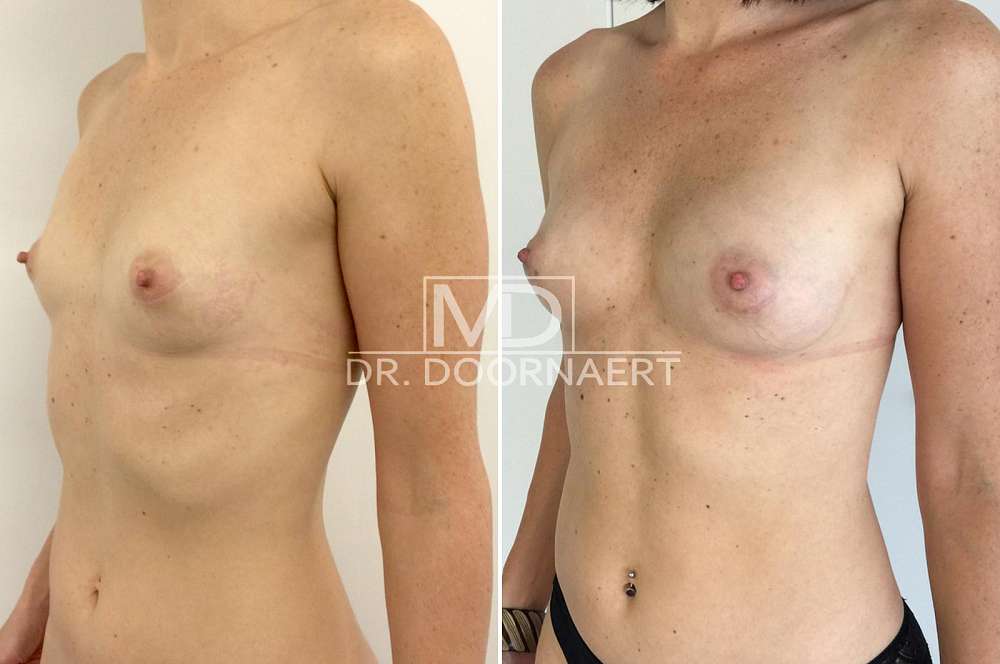 Lipofilling - Body surgery