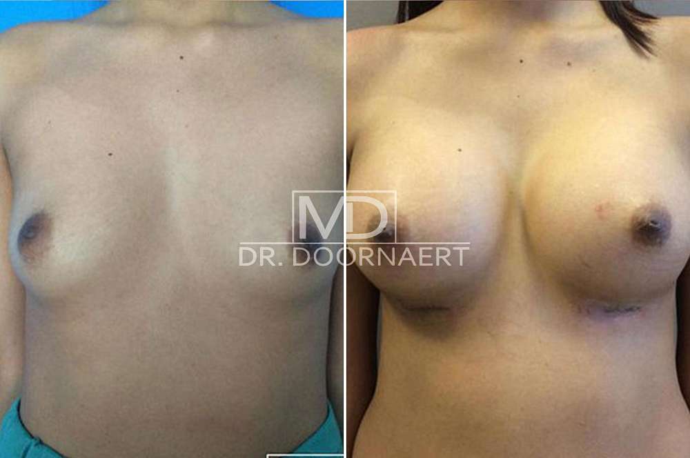 Breast augmentation - Body surgery