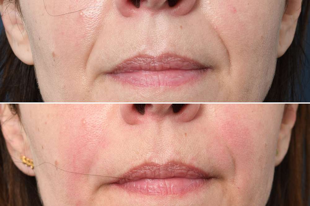 Fillers - Injectables