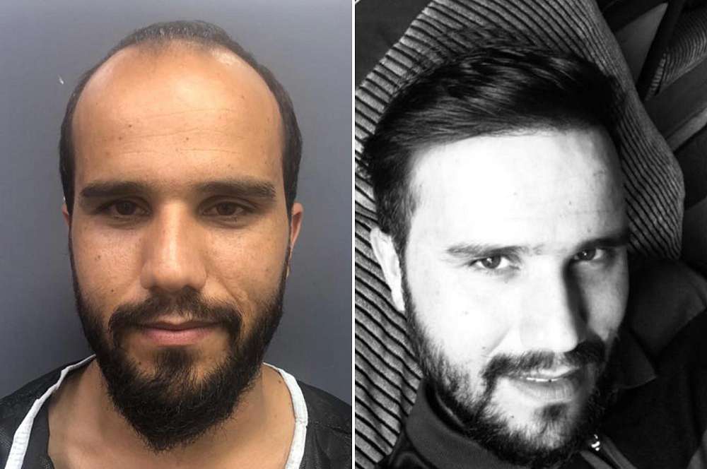 Hair transplant - Hair surgery