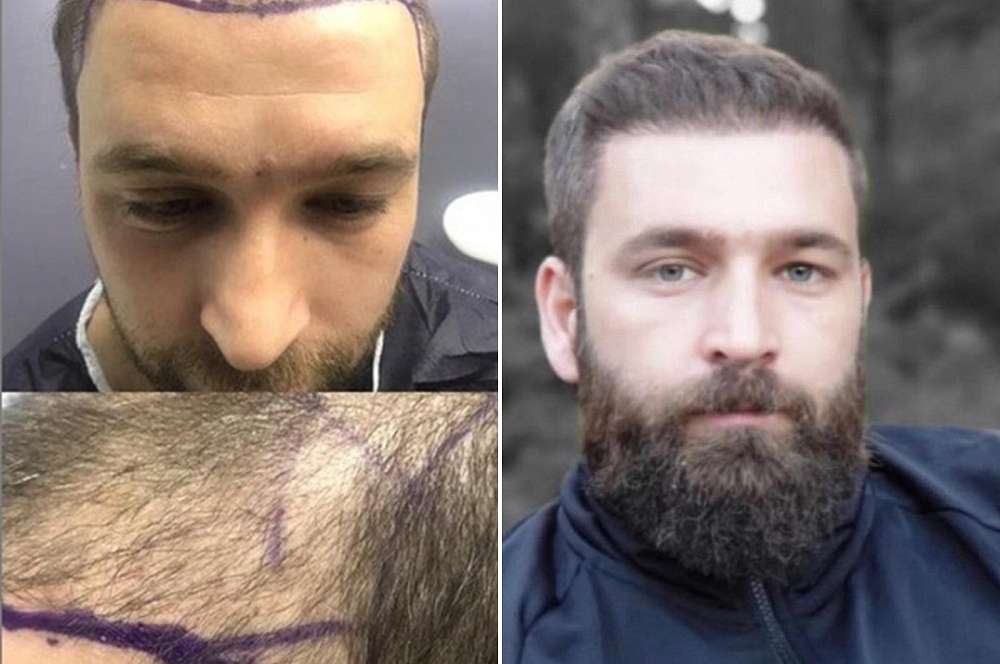 Hair transplant - Hair surgery
