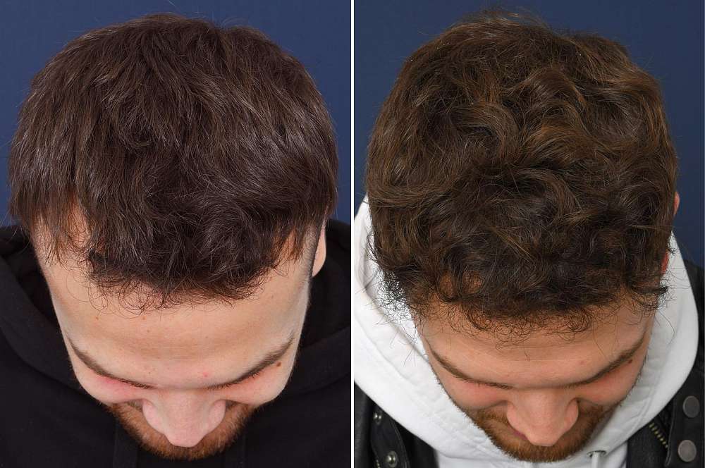 Hair transplant - Hair surgery