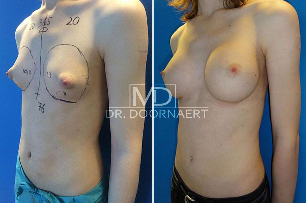 Breast augmentation - Body surgery