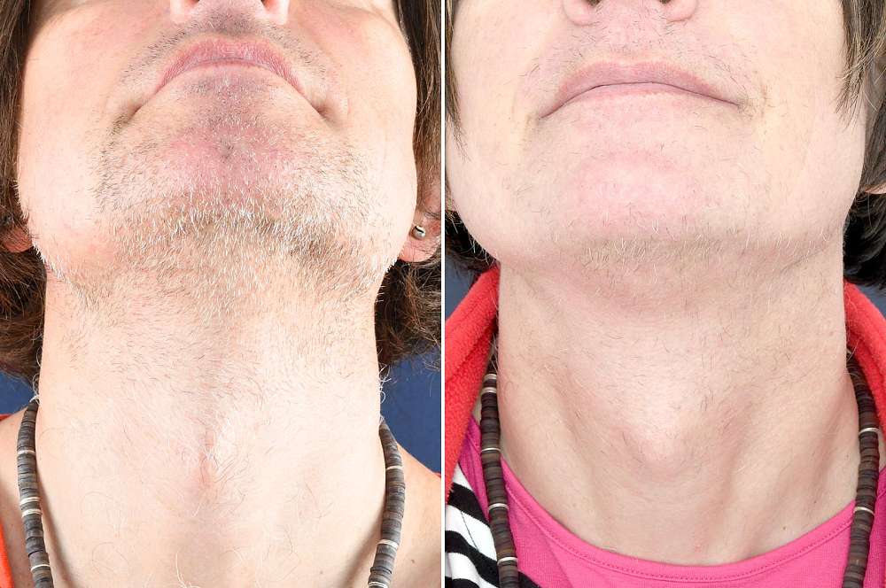 Electrolysis - Hair removal