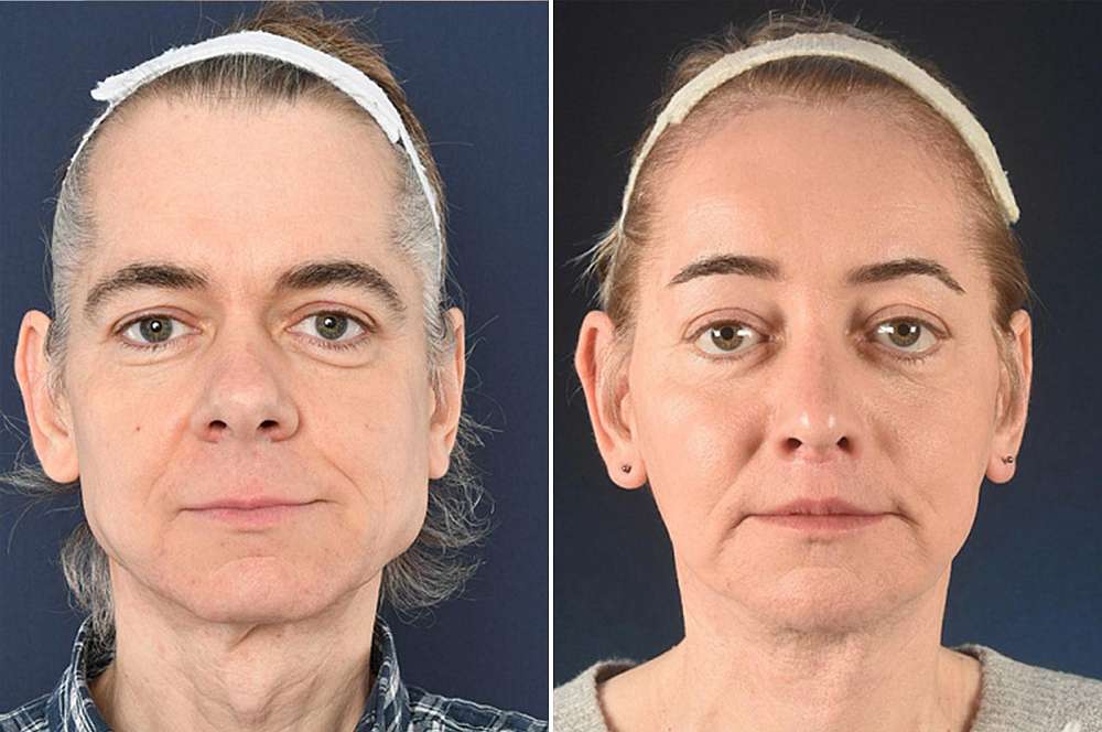 Facial surgery - Facial surgery