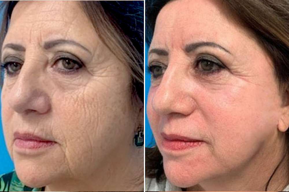 Chemical peel - Facial surgery