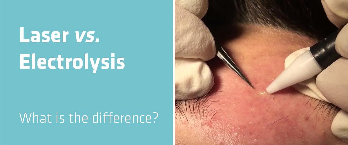 Laser hair removal vs Electrolysis: what is the difference?