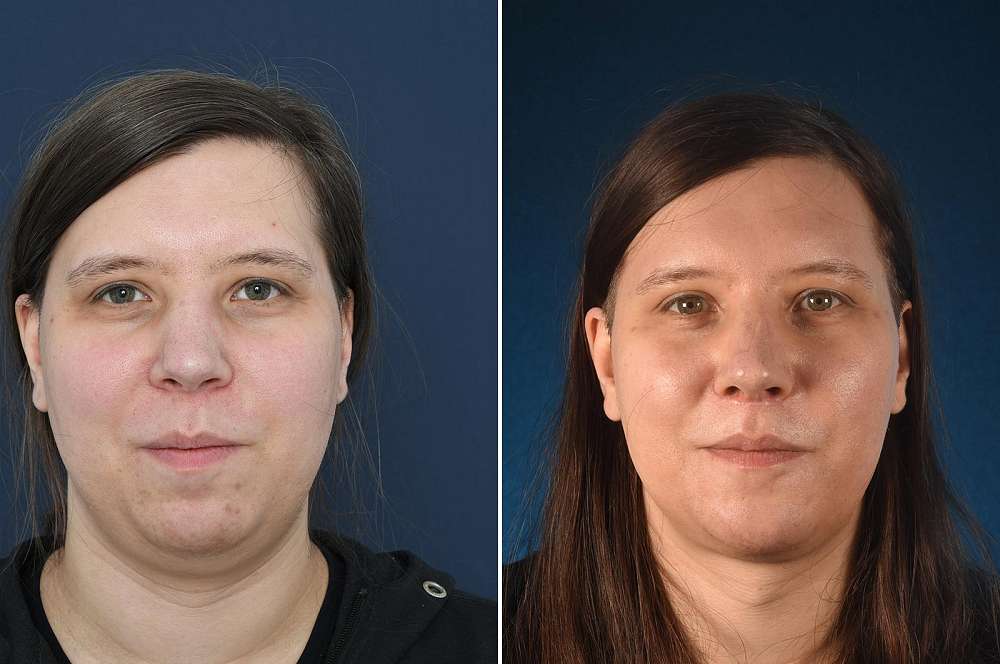 Facial surgery - Facial surgery