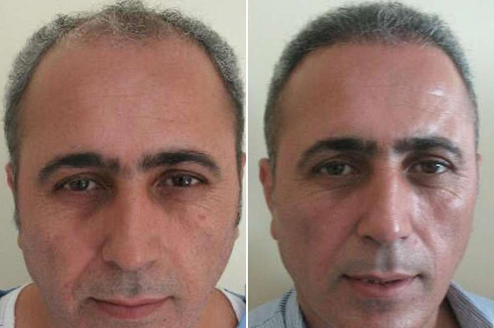 Hair transplant - Hair surgery