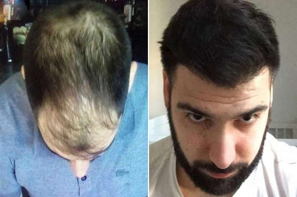 Hair transplant - Hair surgery