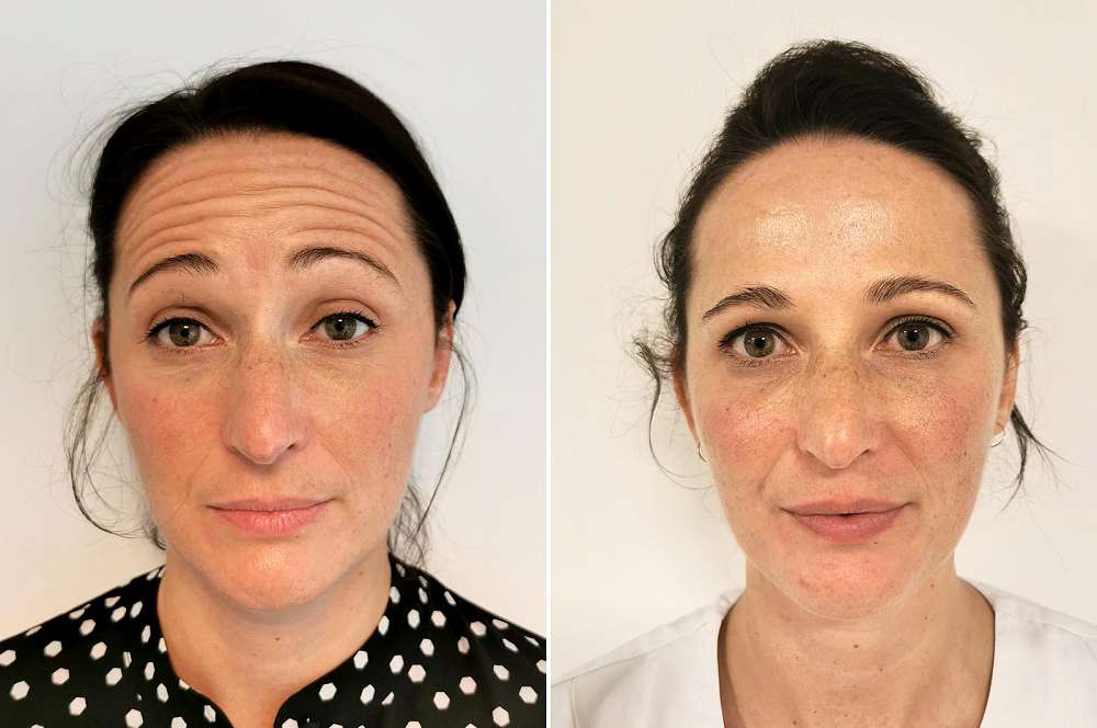 Muscle relaxants - Injectables