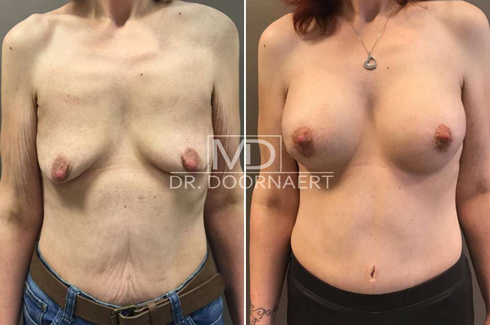 Breast augmentation - Body surgery