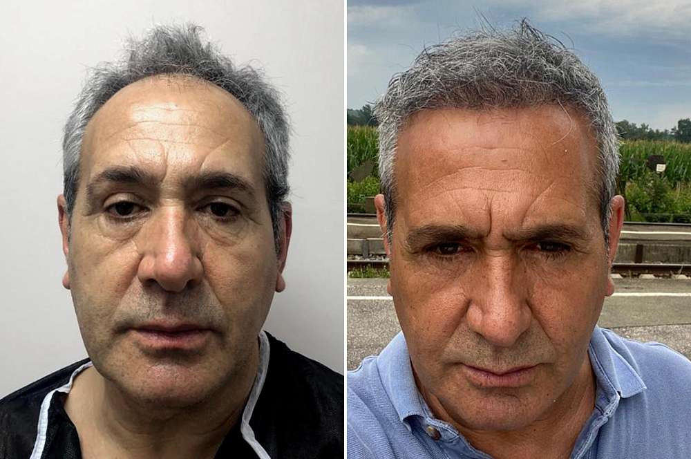 Hair transplant - Hair surgery