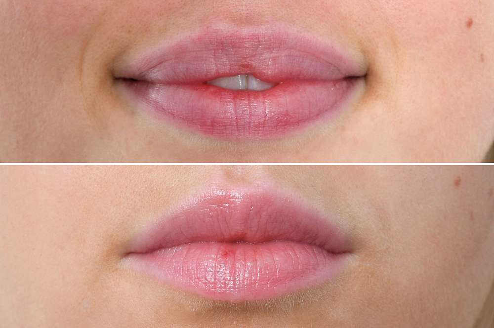 Lip fillers - Injectables