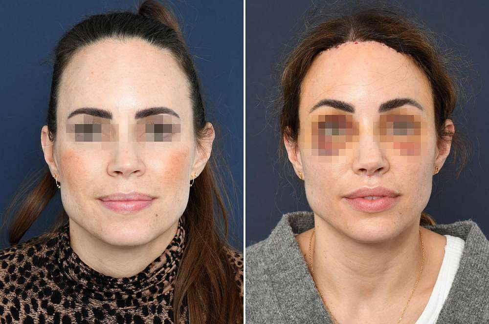 Facial surgery - Facial surgery