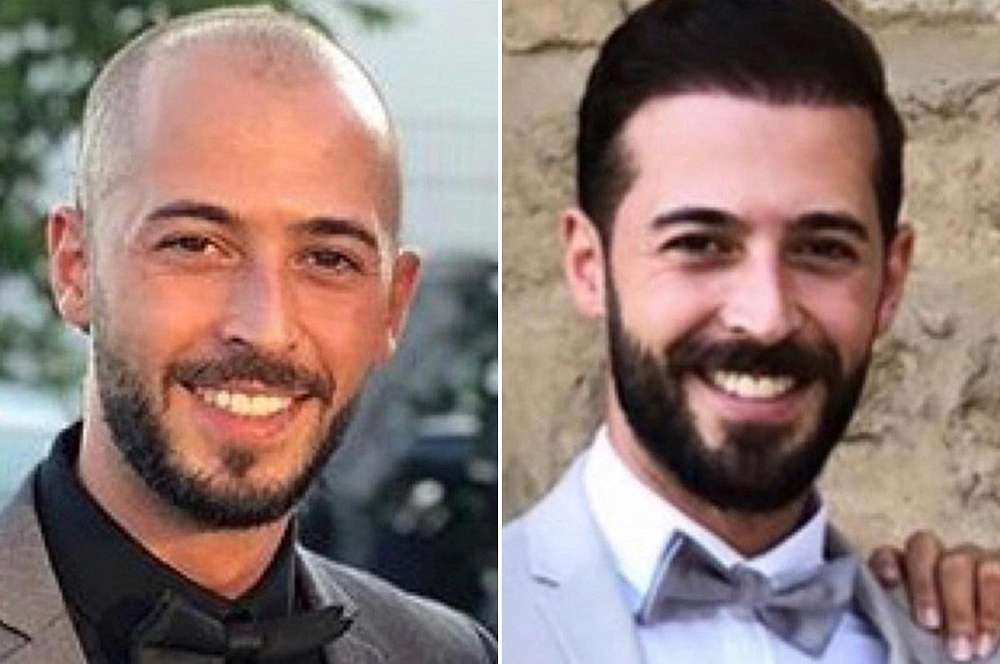Hair transplant - Hair surgery