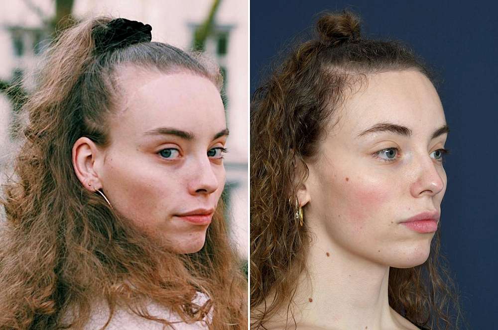 Hair transplant - Hair surgery