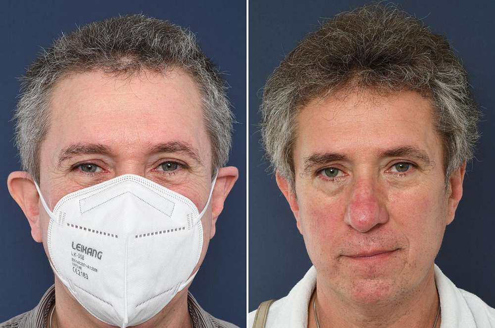 Hair transplant - Hair surgery