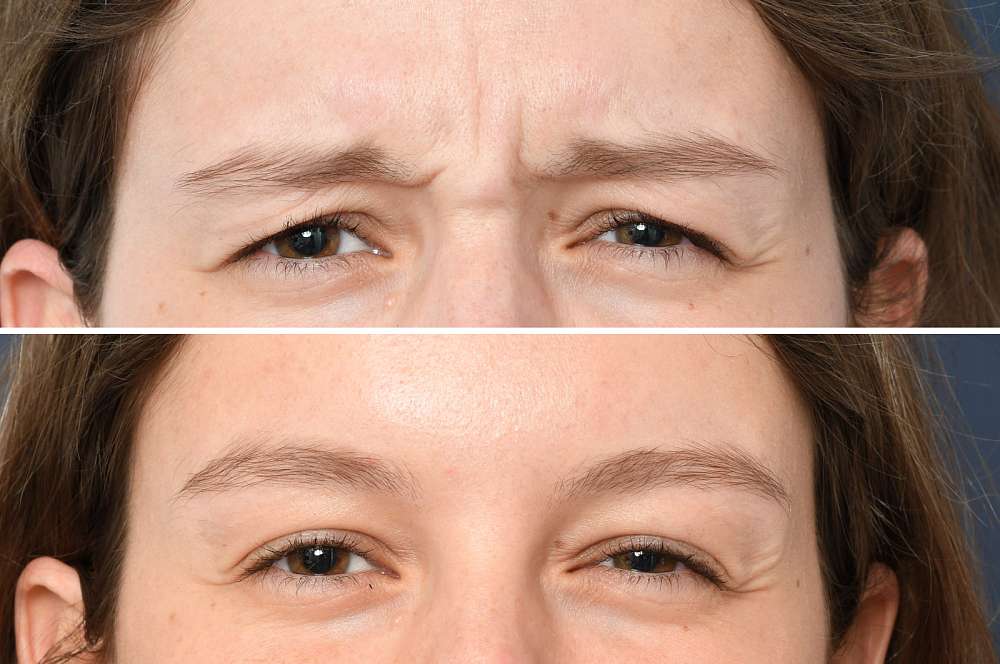 Muscle relaxants - Injectables