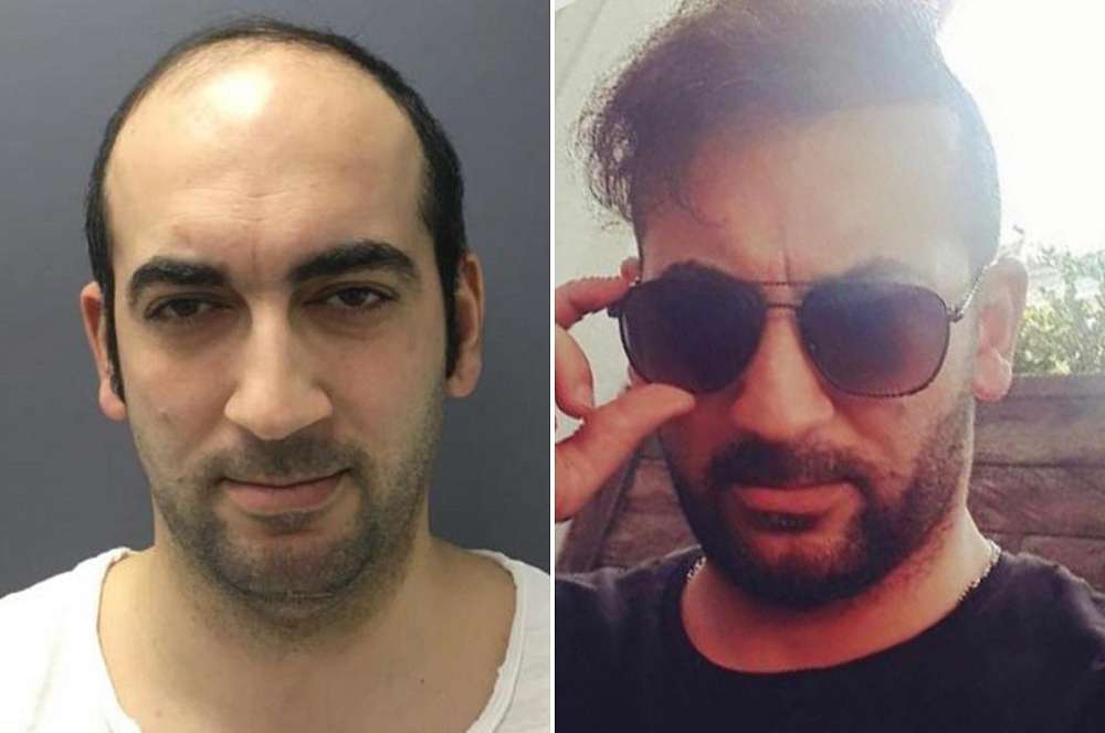 Hair transplant - Hair surgery