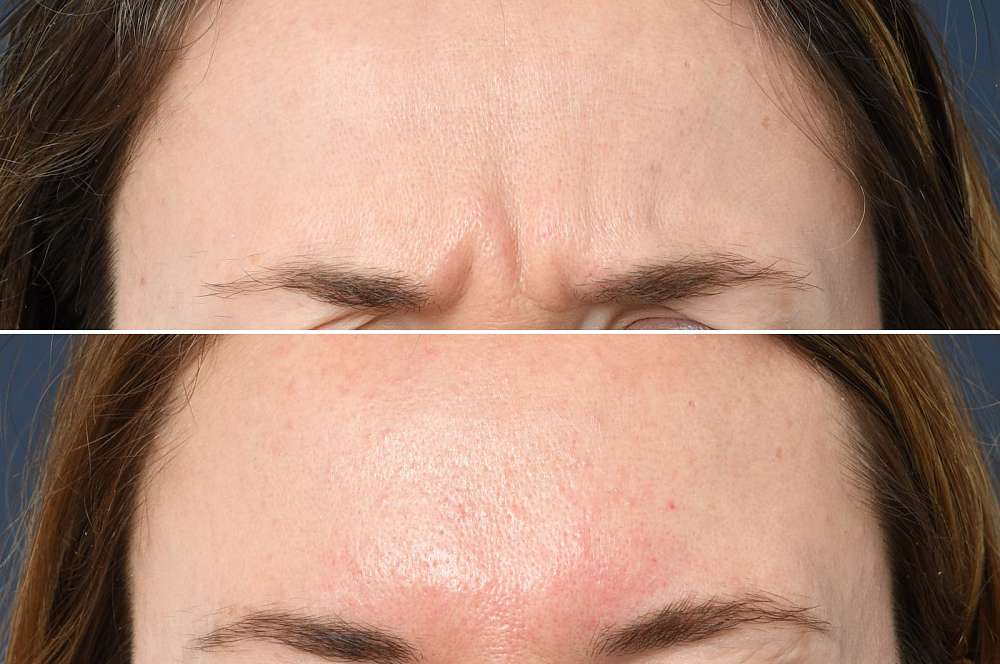 Muscle relaxants - Injectables