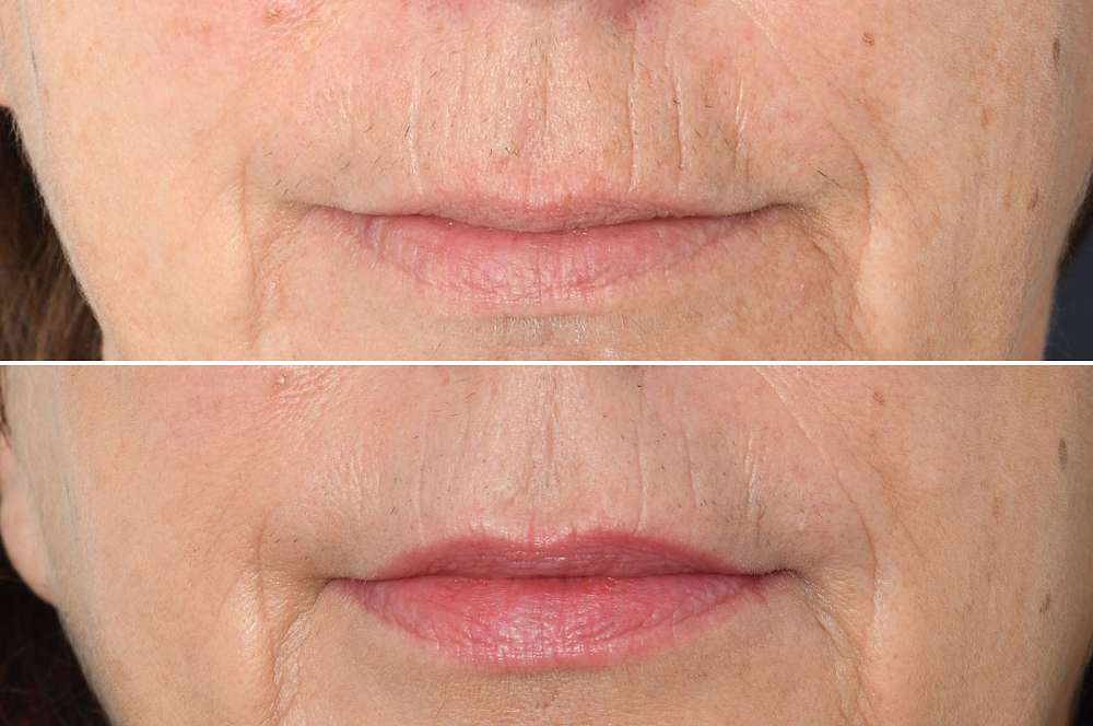 Fillers - Injectables