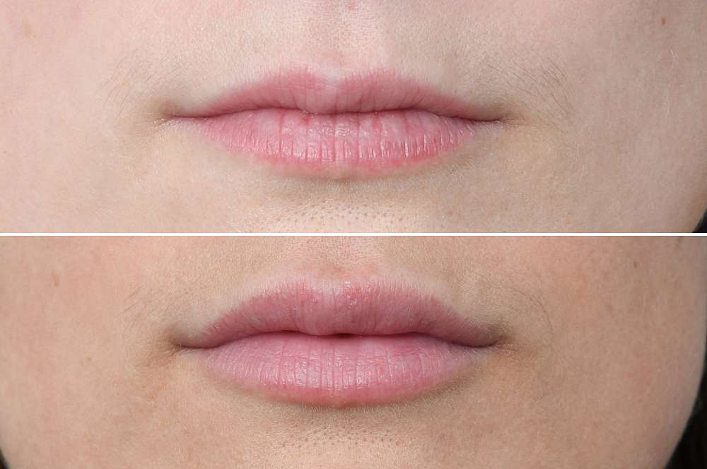 Lip fillers - Injectables