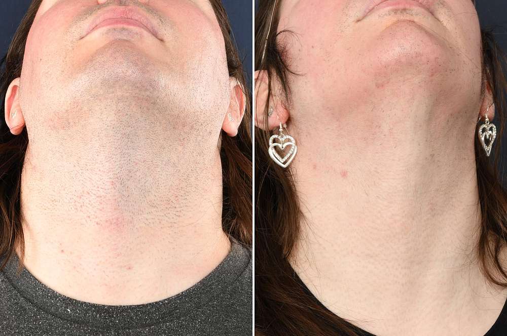 Laser and electrolysis - Hair removal