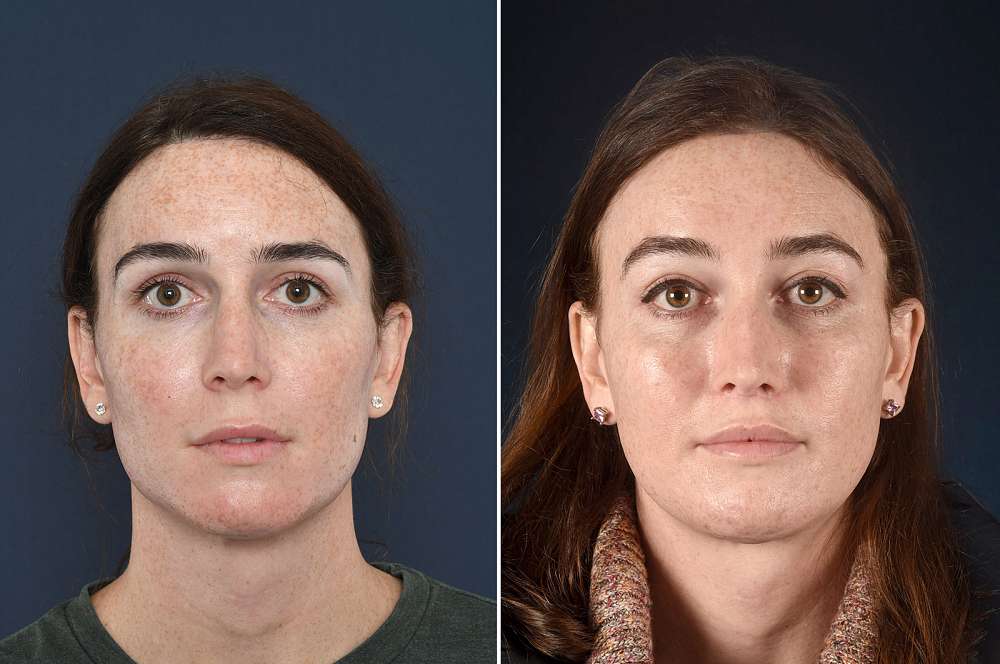 Facial surgery - Facial surgery