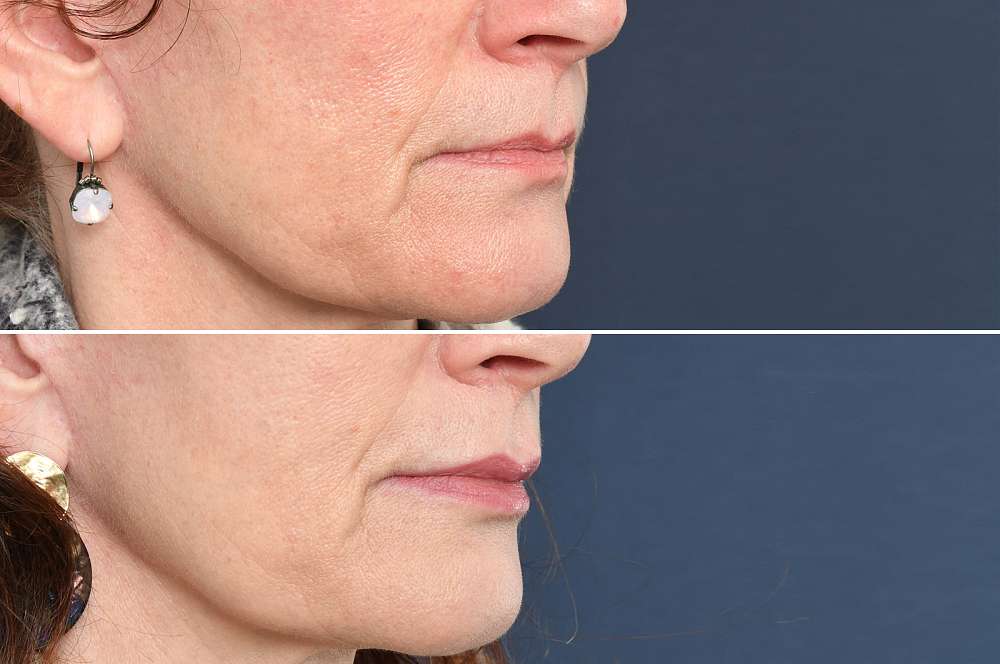 Fillers - Injectables