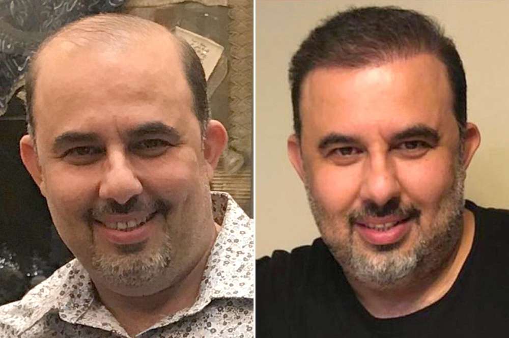 Hair transplant - Hair surgery